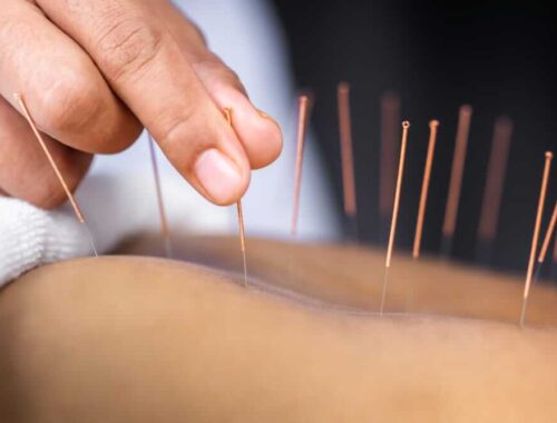 Acupuncture Needles on the back of a person