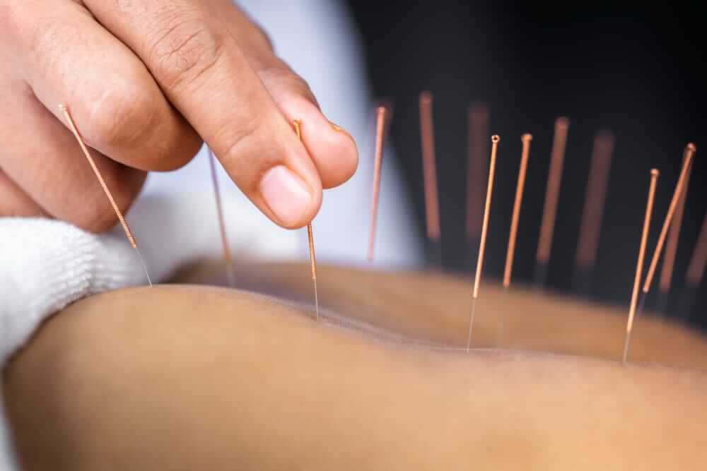 Acupuncture Needles on the back of a person