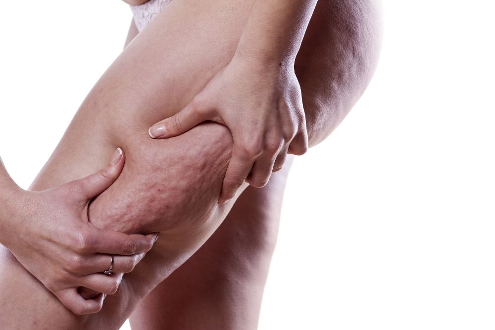 cellulite-reduction-treatment-auckland