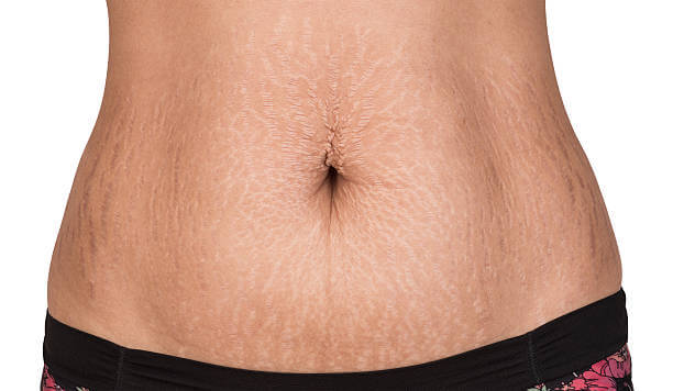 Stomach Skin Tightening