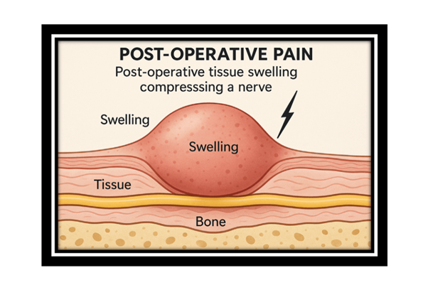 Post-Operative-Pain-Auckland-Interactive-Theraphies